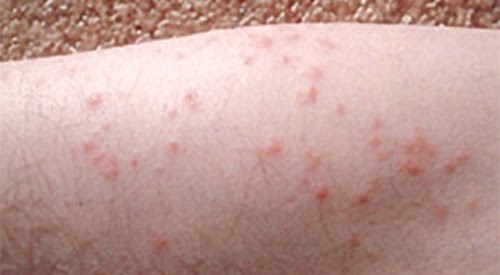 rash on an arm