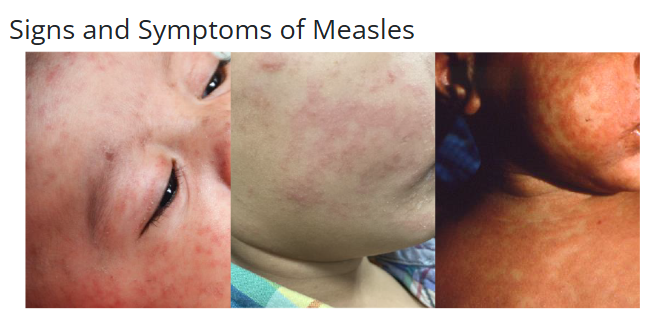 Signs & Symptoms of Measles