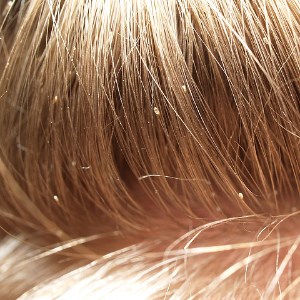 Head lice on hair