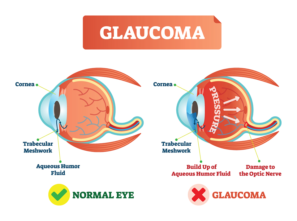 Glaucoma info