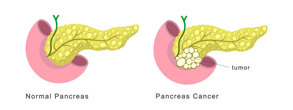 Pancreatic Cancer graph