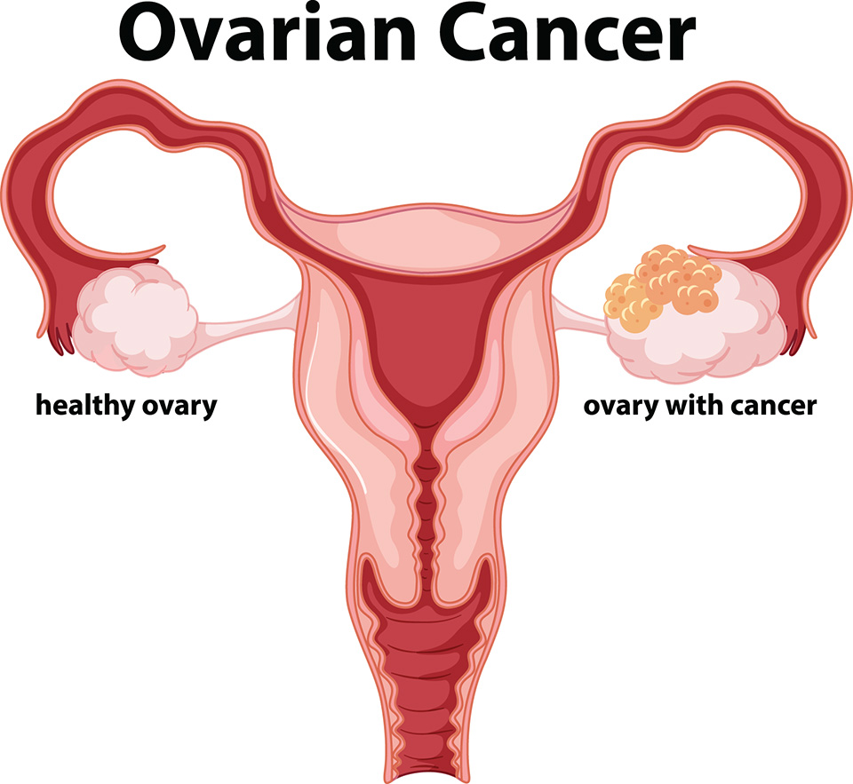 Ovarian Cancer info