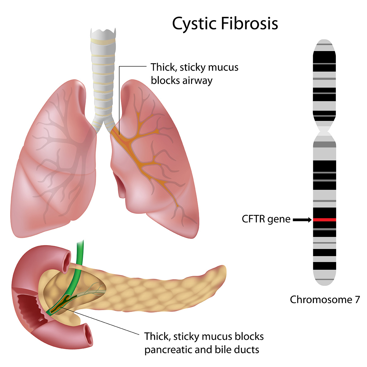 Cystic Fibrosis graph