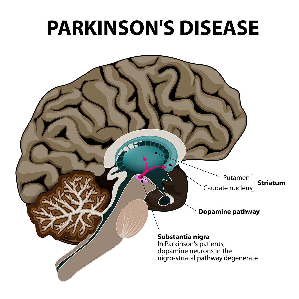 Parkinson's Disease graph