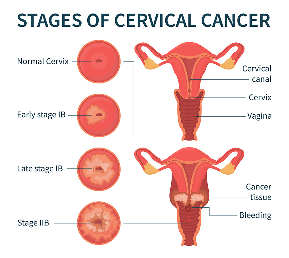 Cervical Cancer info