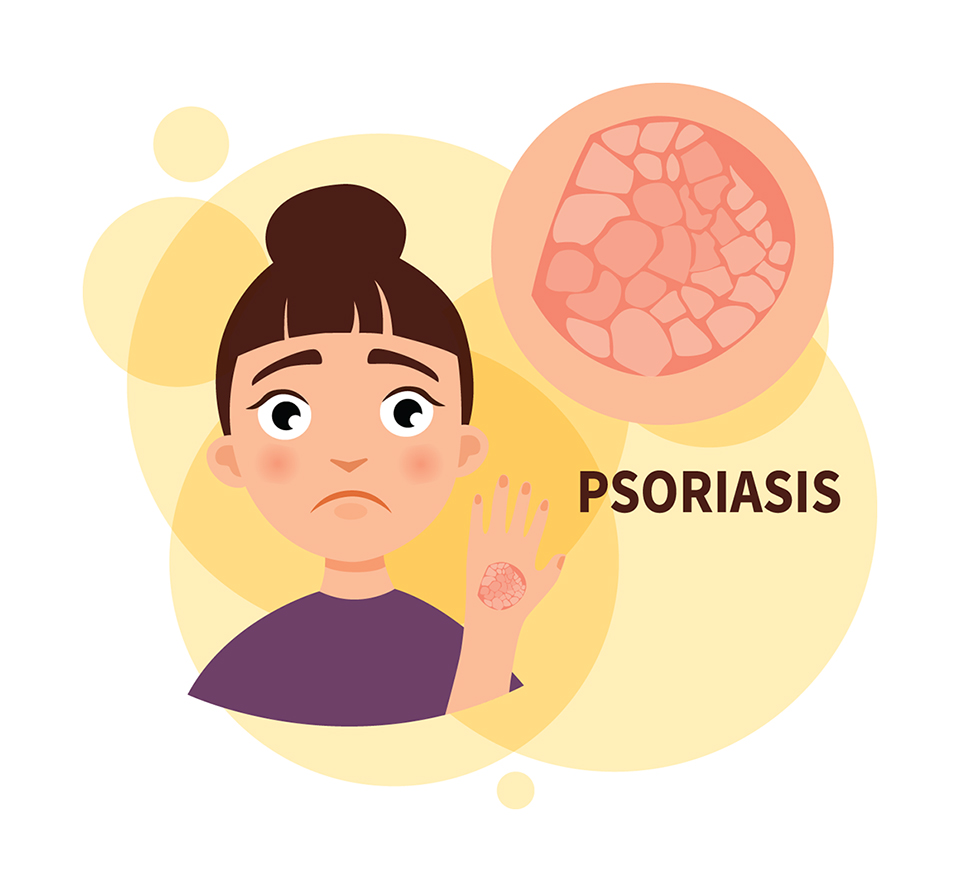 Psoriasis clip art