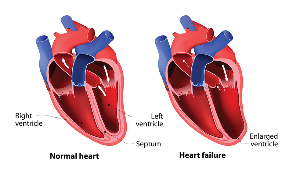 Heart Failure example