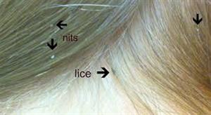 Lice examples