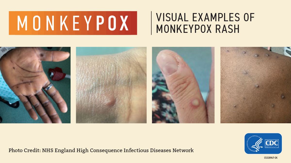 monkeypox