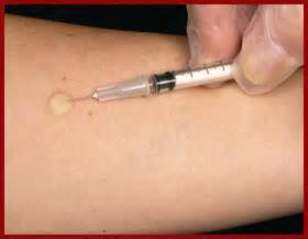 TB skin test