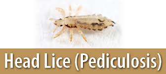 Head Lice image