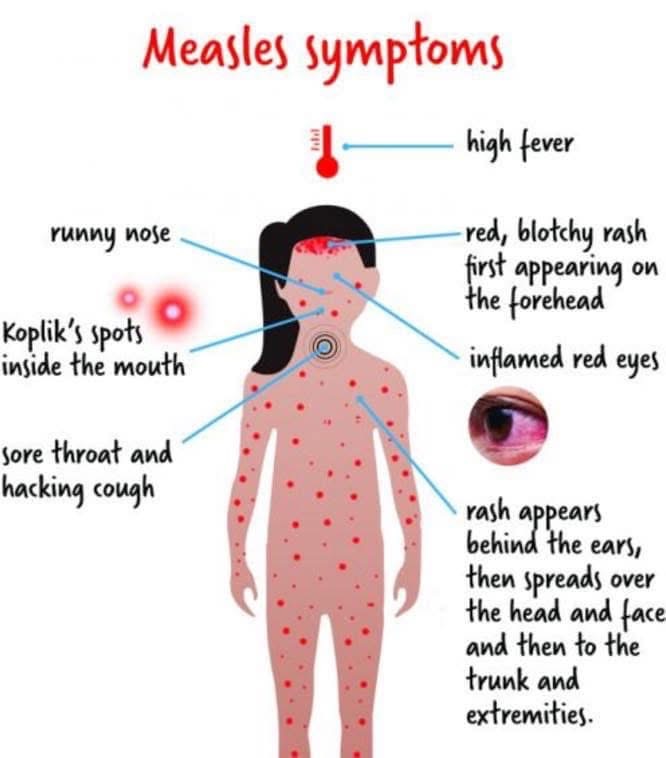 measles symptoms