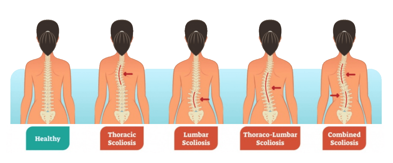 Types of Scoliosis