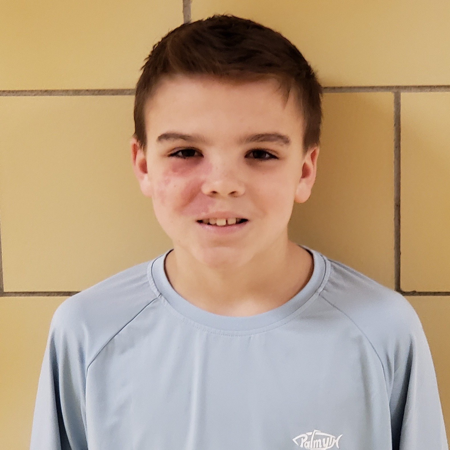 smiling boy with dark hair and red birthmark wearing a gray t-shirt